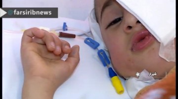 عمل جراحی نادر روی صورت کودک شیراز